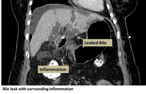 Bile Leaks